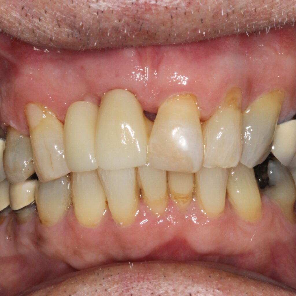 Maryland Bridges to replace missing teeth