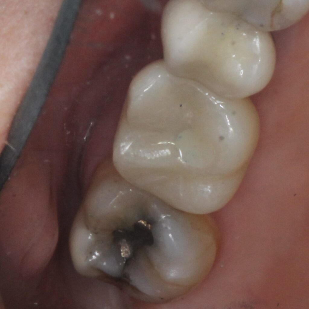 After - New Implant Crown