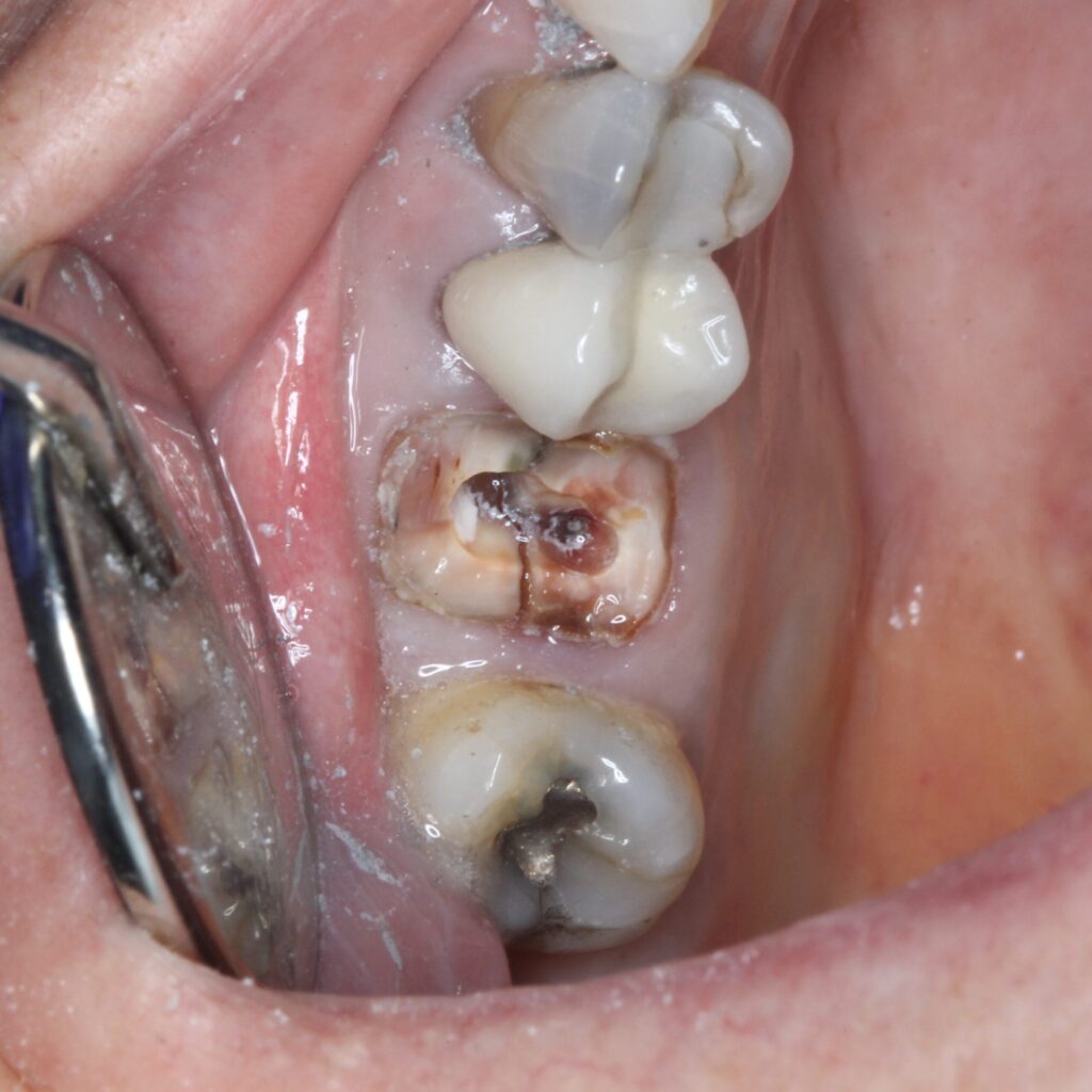 Before - Cracked Tooth